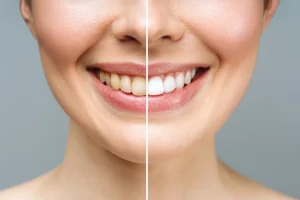 Stained teeth are more than a cosmetic issue. Read more and learn how Soft Touch Dentistry can fix stained teeth in Sacramento?