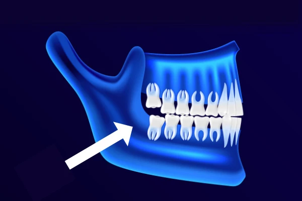 Diagram Location of Wisdom Teeth